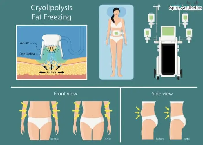 Fat freezing treatment West Bridgford benefits for competitions to remove stubborn fat deposits.
