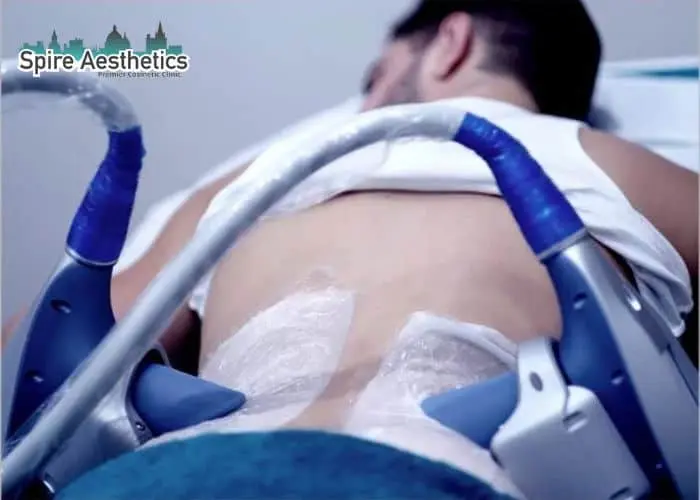 Man having fat freezing treatment done on love handles before a competitions West Bridgford to create a sculpted look.