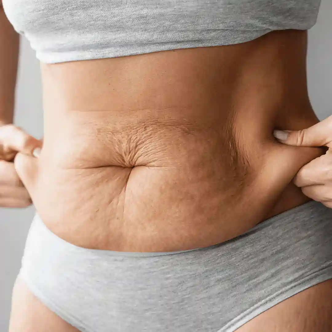 Is It Normal to Have Loose Skin After Pregnancy West Bridgford?
