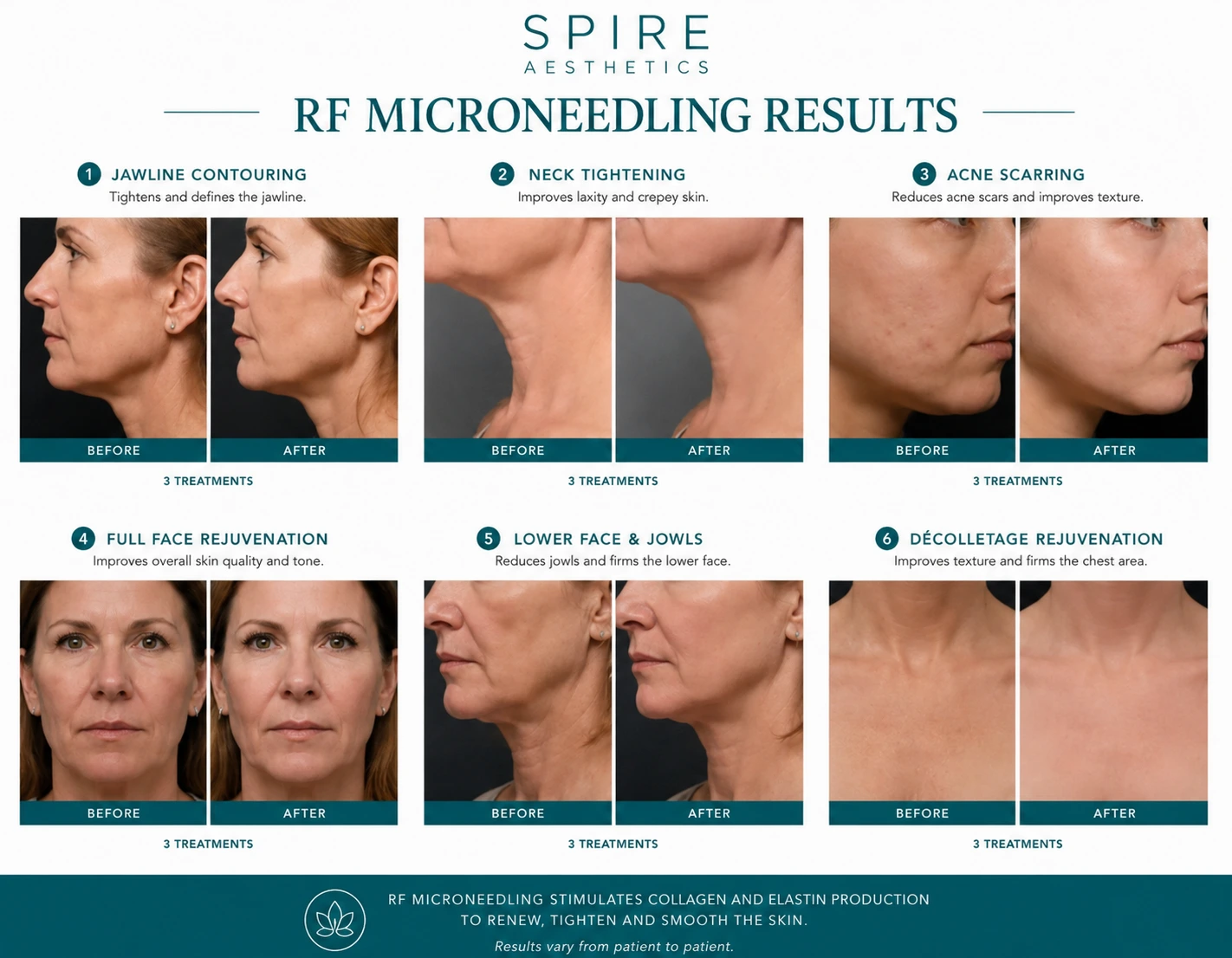 RF Microneedling Skin tightening West Bridgford results