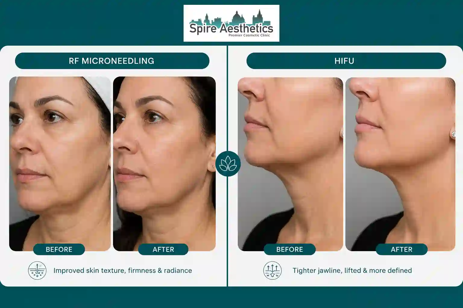 Can RF Microneedling and HIFU Be Combined West Bridgford?