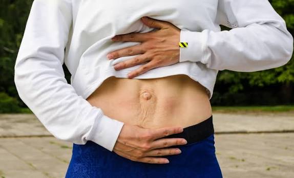 When Could Diastasis Recti Be the Missing Piece of the Puzzle West Bridgford?