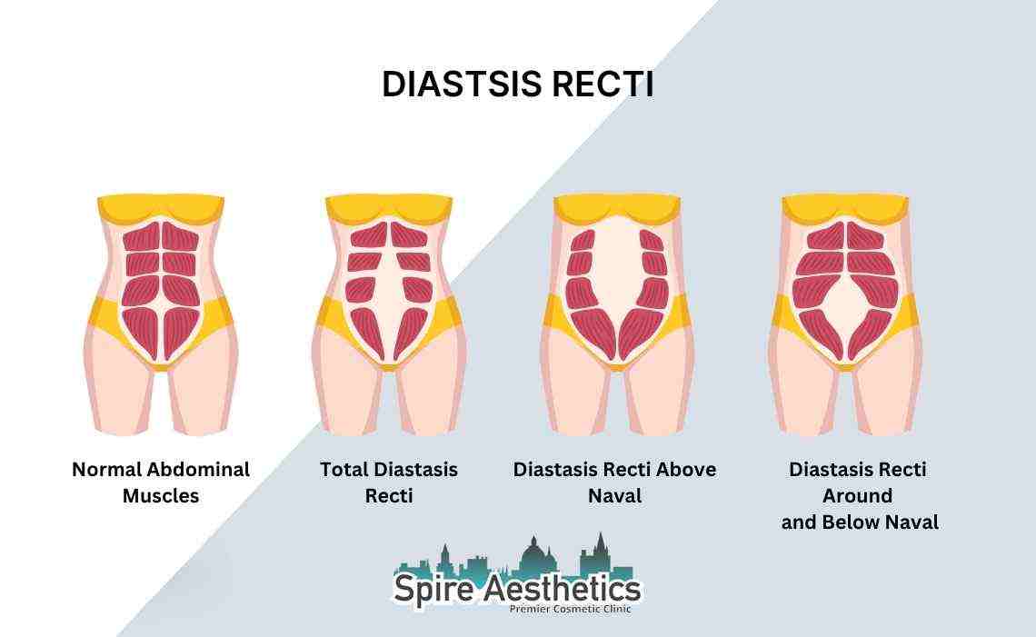 Is Non-Surgical Diastasis Recti Treatment Right for You? Common Concerns Answered West Bridgford